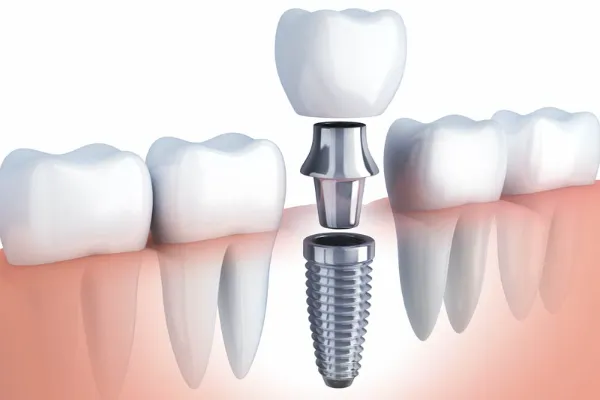 dental implants