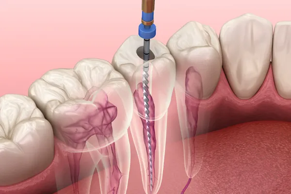 root canal