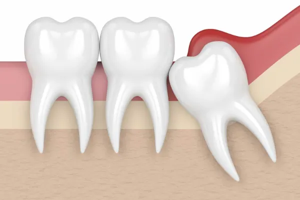 wisdom teeth removal