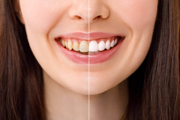 before and after image showing the results of teeth whitening