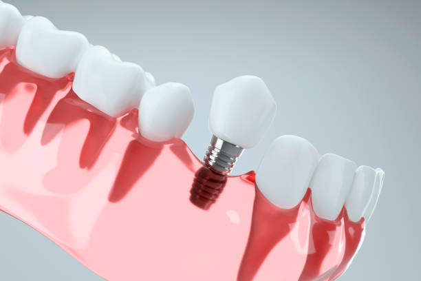a photo showing a dental implant and its parts