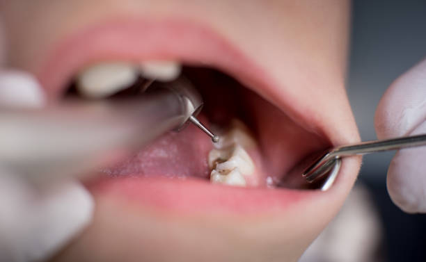 photo showing a tooth with cavities