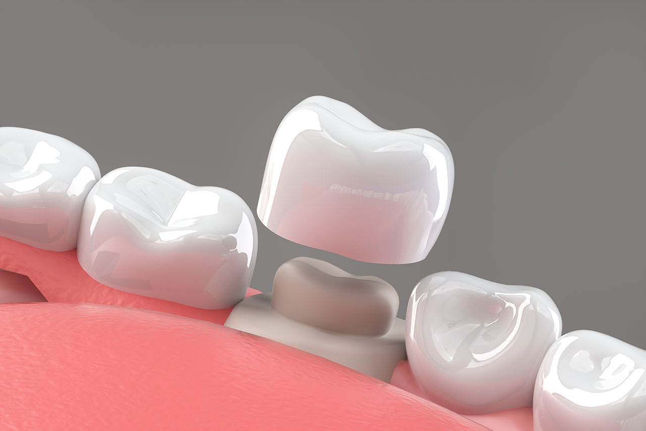 Dental Crowns in Denville: Strong, Natural-Looking Protection for Damaged Teeth